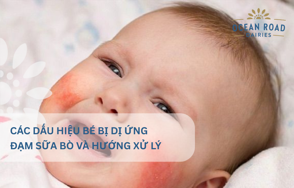 Các dấu hiệu bé bị dị ứng đạm sữa bò và hướng xử lý